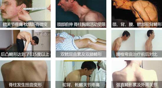 成都风湿医院强直性脊柱炎引起脊椎弯曲、关节疼痛.jpg