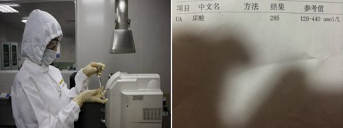 成都风湿医院尿酸检查.jpg